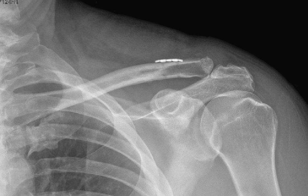 AC Joint Dislocation