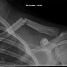 normal clavicle xray