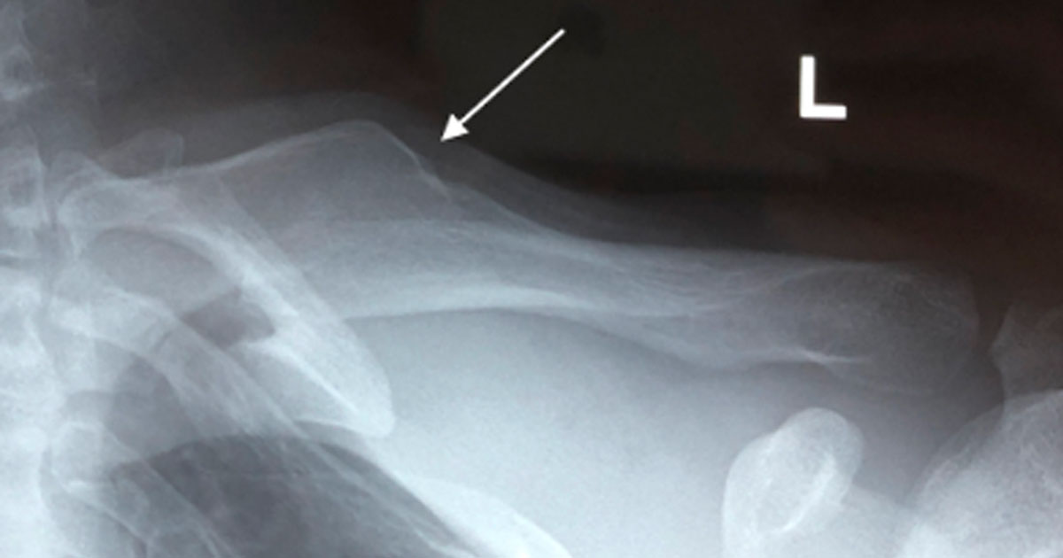 clavicle-malunion-in-a-29-year-old